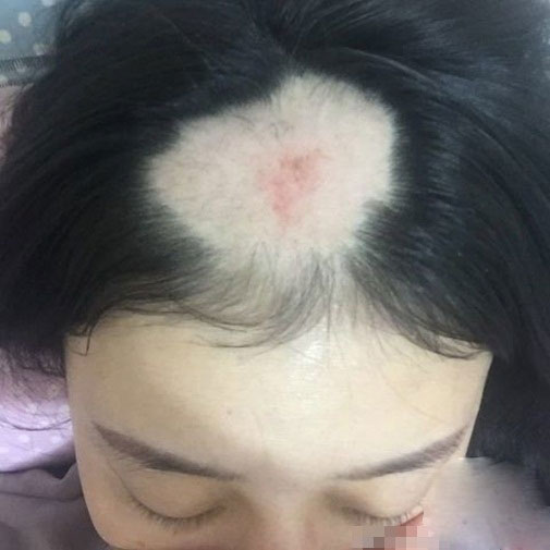 Gặp lại cô gái bay cả da đầu vì ăn ngô bằng máy khoan - 2