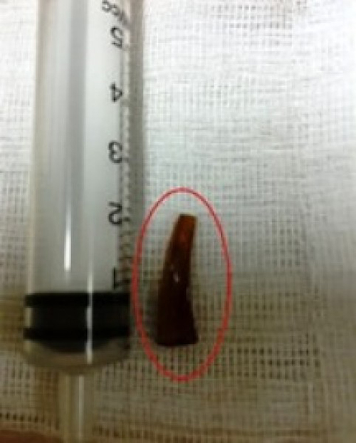 Mảnh thủy tinh nằm trong tai 50 ngày mới phát hiện - 1