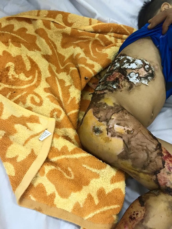 Hà Nội: Bé trai 4 tuổi hoại tử da vì đắp lá thầy lang chữa bỏng - 1
