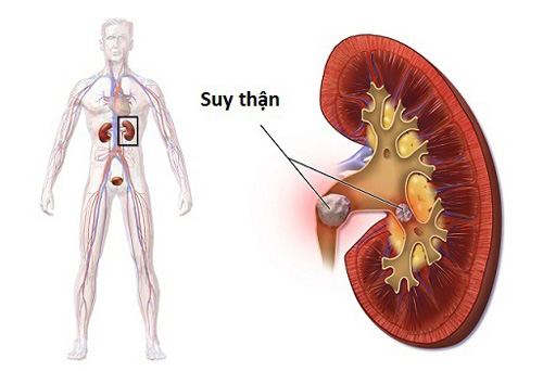 Cảnh báo: Biến chứng về thận ở bệnh nhân tiểu đường - 1