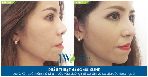 4 điều cấm kị cần biết khi nâng mũi - 2
