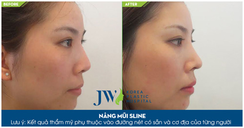4 điều cấm kị cần biết khi nâng mũi - 3