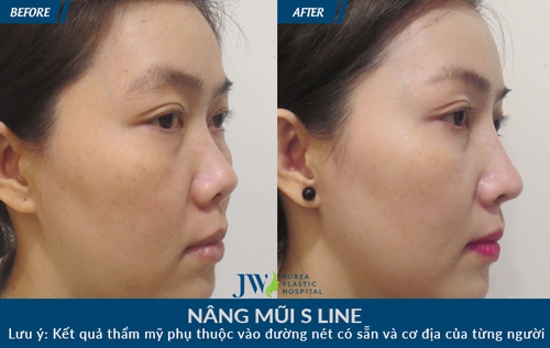 4 điều cấm kị cần biết khi nâng mũi - 4