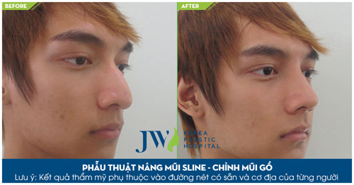4 điều cấm kị cần biết khi nâng mũi - 6