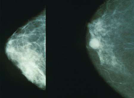 Liệu pháp “bỏ đói” tế bào ung thư vú - 1