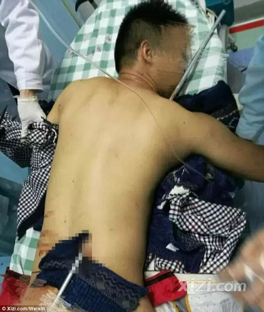 Bị cột thu lôi đâm xuyên qua người vẫn sống - 1