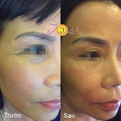 Giá sốc nâng cơ mặt, xóa nhăn trong 90 phút - 1