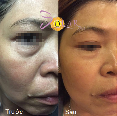 Giá sốc nâng cơ mặt, xóa nhăn trong 90 phút - 2