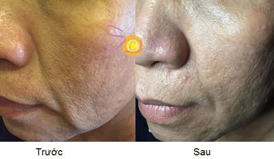 Giá sốc nâng cơ mặt, xóa nhăn trong 90 phút - 3