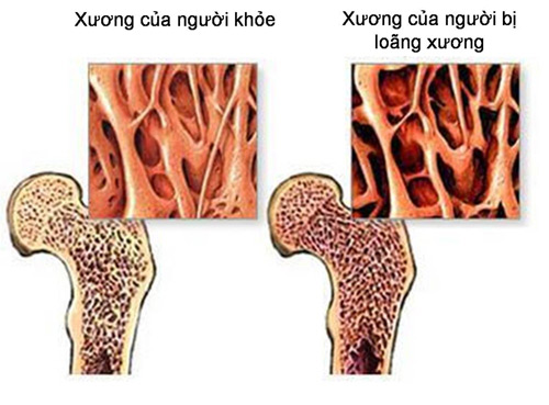 Bổ sung canxi không đúng cách, coi chừng rước họa vào thân! - 1