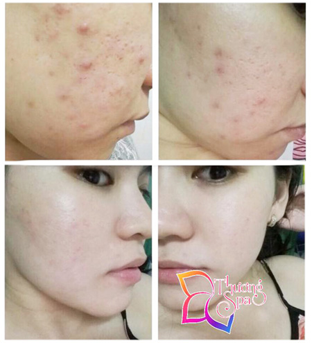 Sạch mụn chỉ với 299.000đ tại Thương Spa! - 1