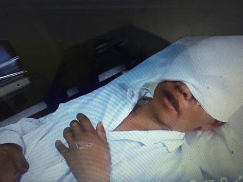 Vào rừng hái măng, người đàn ông bị gấu cào nát 2 mắt - 1