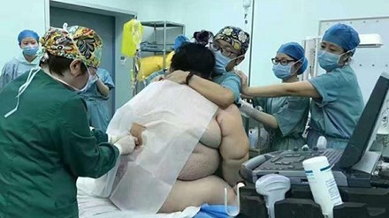 16 y bác sĩ vất vả đỡ đẻ cho bà bầu nặng... 130kg - 1