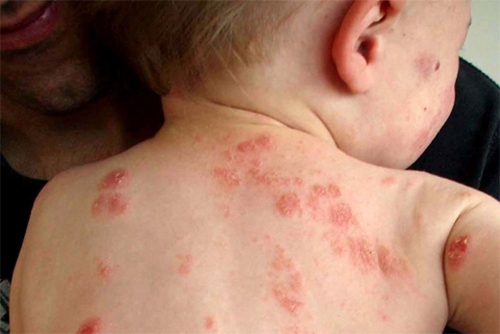 Vì sao mùa đông trẻ nhỏ, người lớn bị ngứa gãi đến chảy máu? - 2
