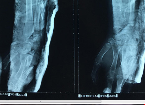 Cứu bệnh nhi bị chân vịt ghe chém gãy xương cánh tay - 1