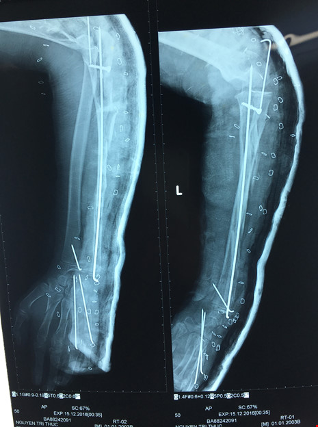 Cứu bệnh nhi bị chân vịt ghe chém gãy xương cánh tay - 2