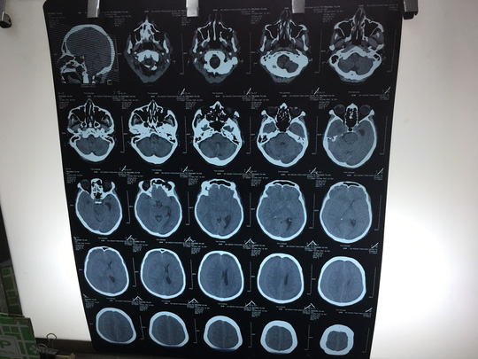 Té sau 3 tháng mới biết chấn thương sọ não - 1