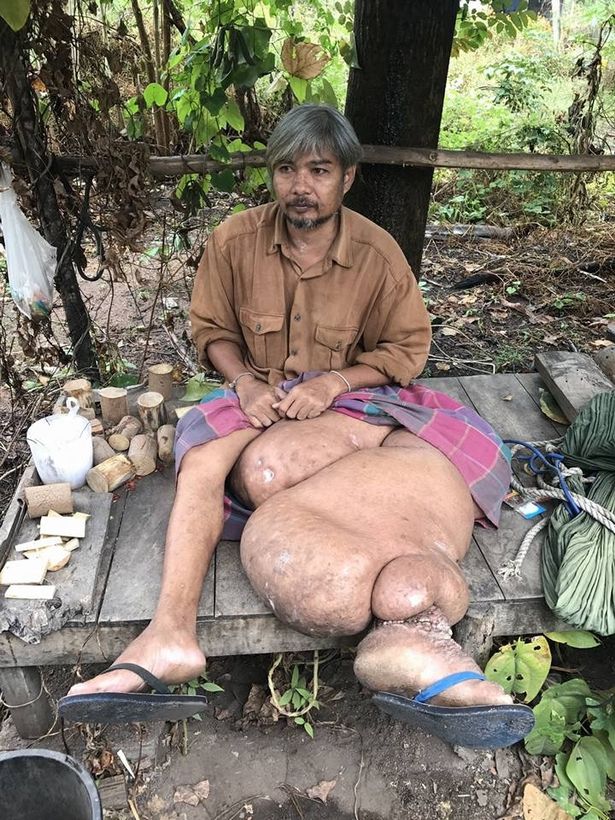 Người đàn ông Thái Lan khốn khổ vì chân to như voi - 1