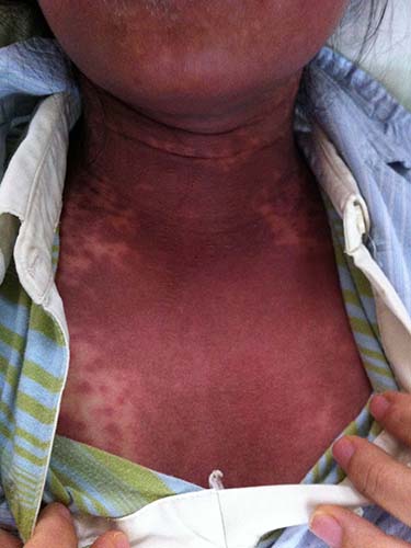 Dị ứng thuốc ngày càng đáng sợ! - 1