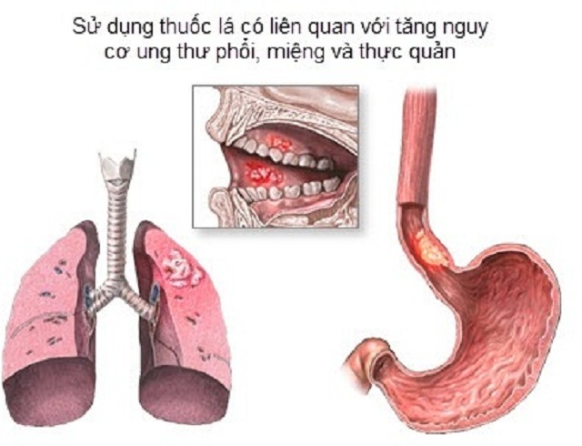 Nguy cơ ung thư khi sử dụng thuốc lá - 2