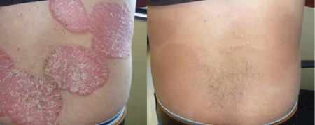 Cải thiện chất lượng cuộc sống ở bệnh nhân vảy nến - 2