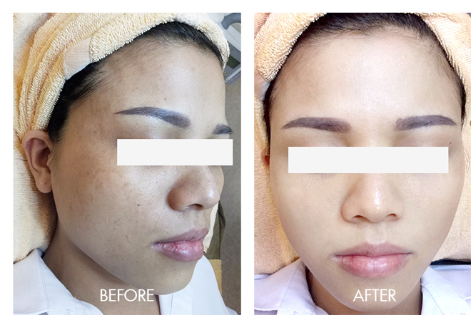 Cách trị tàn nhang, nám và “thổi bay” sạm da không hề khó - 4