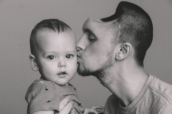 Tình yêu người vợ dành cho chồng chỉ có nửa hộp sọ - 2