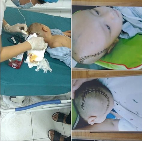 Thái Bình: Trẻ mầm non bị xuất huyết não sau khi ngã ở trường - 1