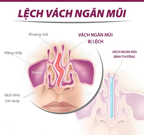 Khắc phục chứng nghẹt mũi khi chuyển mùa - 2