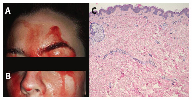 Hoảng sợ vì máu túa ra từ mặt suốt 3 năm mà không có vết thương nào - 1