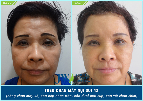 Treo chân mày nội soi 4X níu lại thanh xuân cho chị em U50 - 6