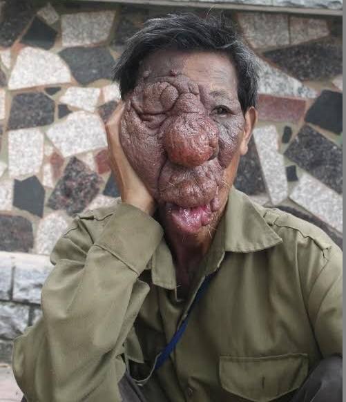 Chuyện đời buồn tủi của người đàn ông "mặt quỷ" - 2