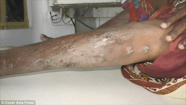 70 cây đinh tự trồi ra khỏi chân 1 phụ nữ - 2