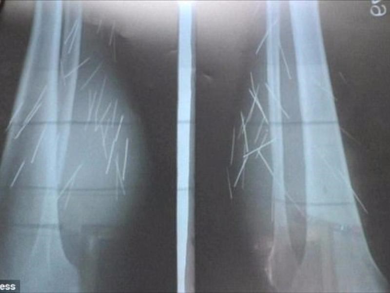 70 cây đinh tự trồi ra khỏi chân 1 phụ nữ - 4