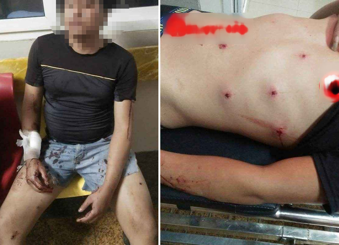 Bị truy đuổi, “cẩu tặc” rút súng bắn 2 người dân nhập viện - 1