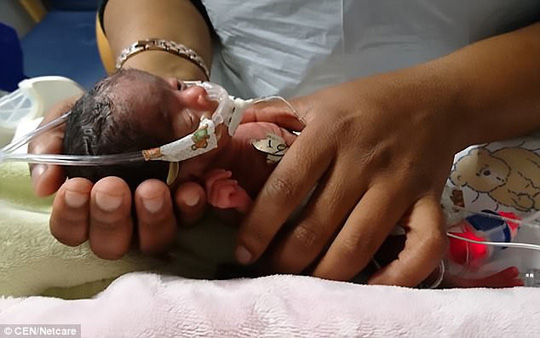 Sinh non nặng 395 g, bé gái tí hon gây choáng váng - 2