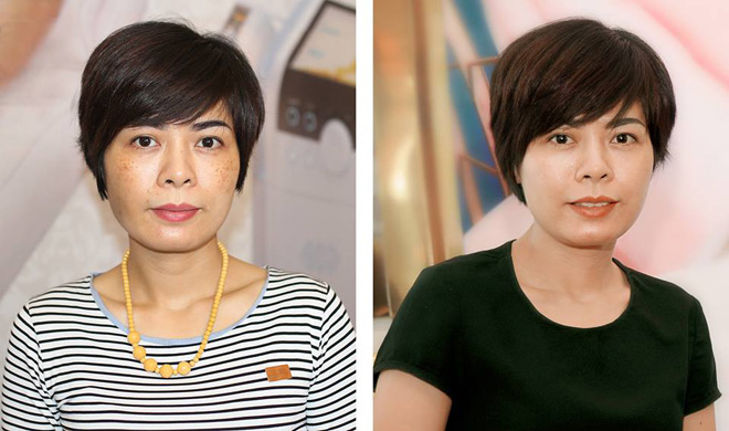 Giải cứu làn da bị nám bằng công nghệ hàng đầu thế giới - 4