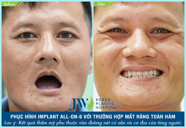 Doanh nhân Hải Phòng chi nửa tỷ làm răng bằng phương pháp lạ - 2