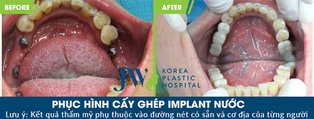 Doanh nhân Hải Phòng chi nửa tỷ làm răng bằng phương pháp lạ - 5