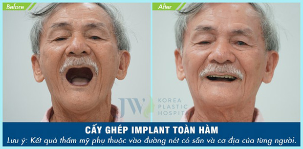 Doanh nhân Hải Phòng chi nửa tỷ làm răng bằng phương pháp lạ - 6