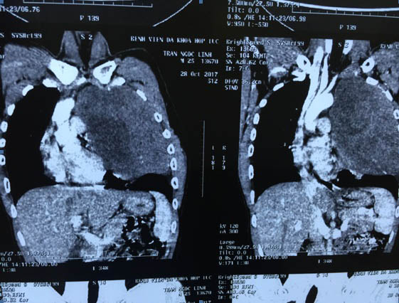 Ho khan, tức ngực tá hỏa phát hiện khối khủng ở lồng ngực - 1