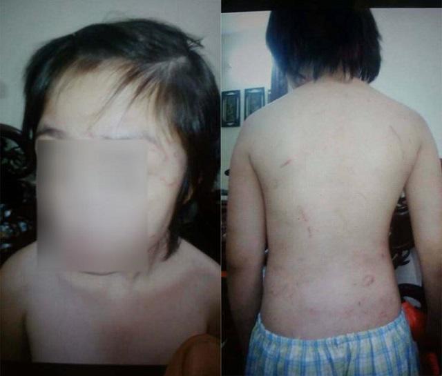 Bé trai 10 tuổi chằng chịt sẹo trên người: Bố đẻ thừa nhận đánh con - 1