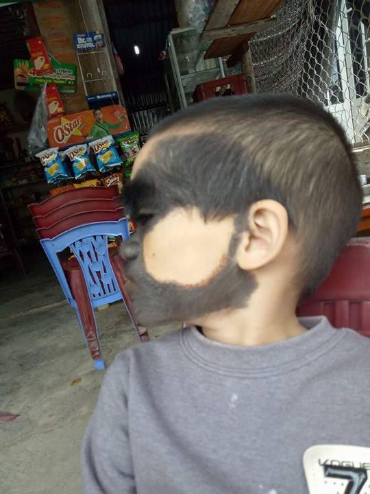 Bé trai 6 tuổi ở Yên Bái có khuôn mặt dị thường, 2 màu trắng đen rõ rệt - 1