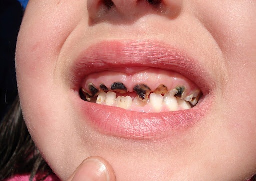 Ðừng để sâu răng gây hậu quả đáng tiếc cho trẻ - 1