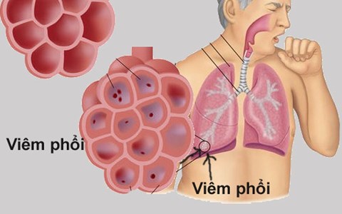 Căn bệnh gây tử vong hàng đầu ở trẻ, cha mẹ cần nhớ các dấu hiệu điển hình này - 1