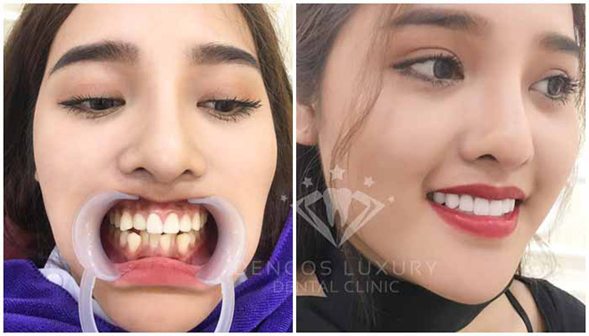 Chào xuân với ưu đãi khủng từ Nha khoa Quốc tế Dencos Luxury - 3