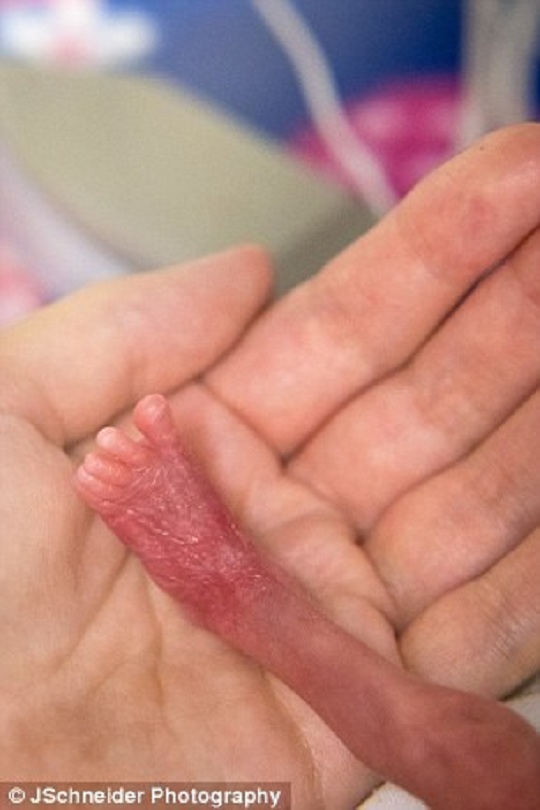 Bị sinh non trước 4 tháng, bé gái nhỏ như lon Coca - 2