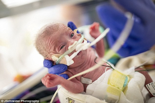 Bị sinh non trước 4 tháng, bé gái nhỏ như lon Coca - 4