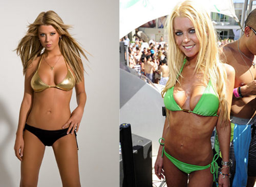 Hiểm họa ngực đẹp từ can thiệp thẩm mỹ - 3